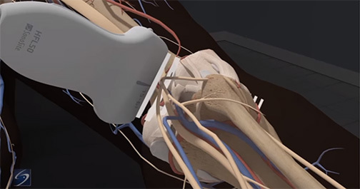 膝窩坐骨神経ブロック | Sonosite Institute for Point-of-Care Ultrasound